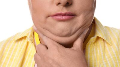 Penyebab Munculnya Double Chin dan Cara Mengatasinya