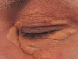 Perhatikan Tanda-tanda Kolesterol Tinggi yang Terlihat di Mata